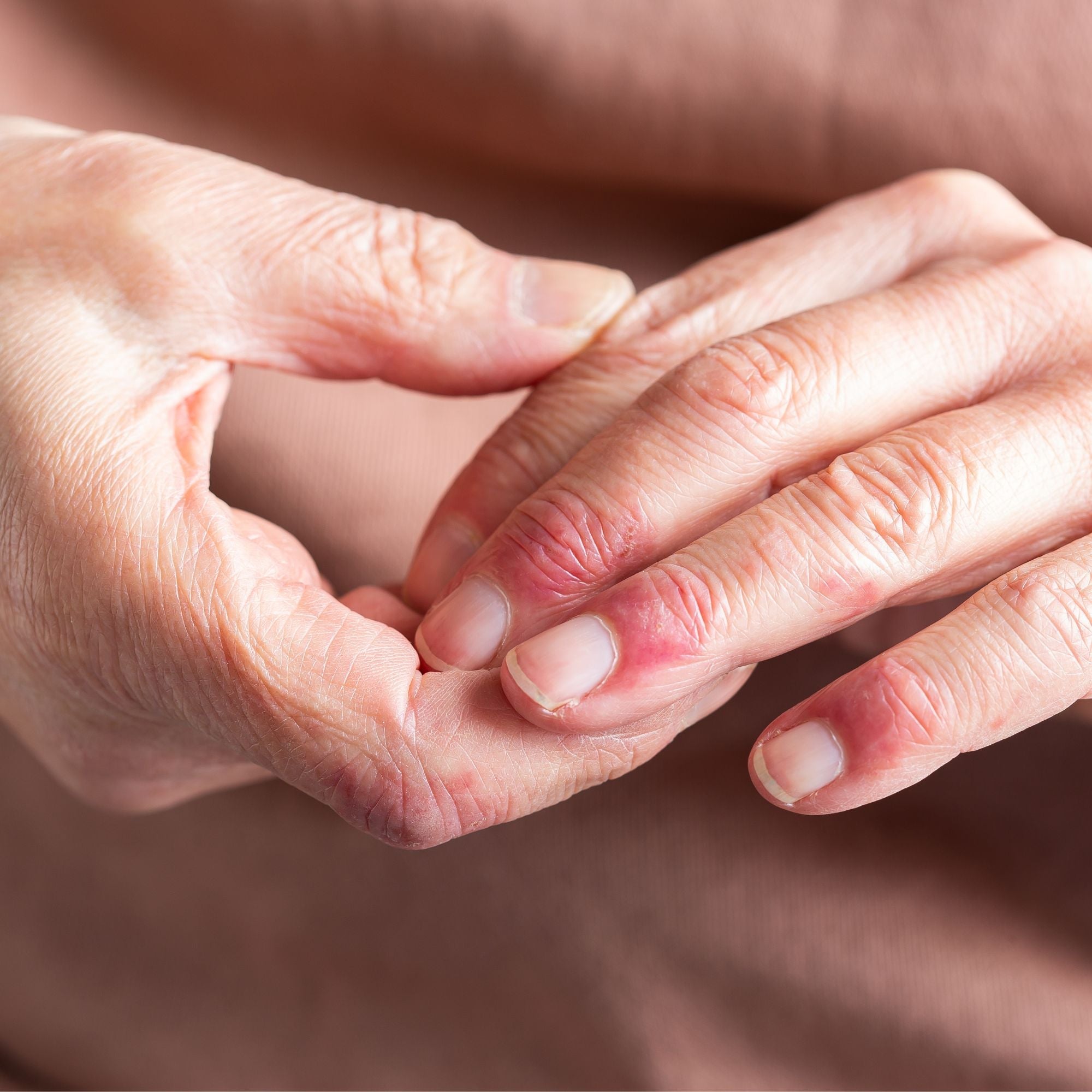 Nail Care During Chemotherapy: How to Manage Brittle Nails, Dryness & Nail Changes in Cancer Treatment